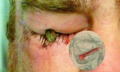 Đinh dài hơn 7cm xuyên vào mắt  vẫn nhìn bình thường