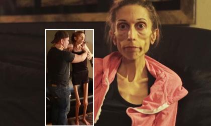 Sự sống của cô gái biếng ăn bị đe dọa nghiêm trọng