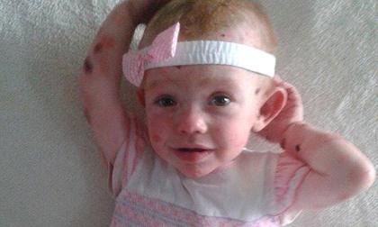 Xót lòng bé gái xinh xắn mắc bệnh chỉ cần chạm nhẹ là da lở loét