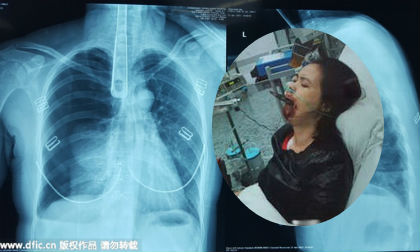 Nuốt thìa sắt dài 30cm để chữa đau họng