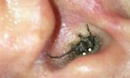 Nhện làm tổ trong tai người