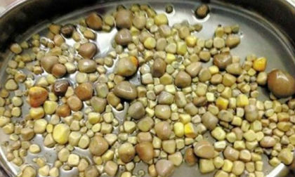Phẫu thuật lấy ra 420 viên sỏi trong thận