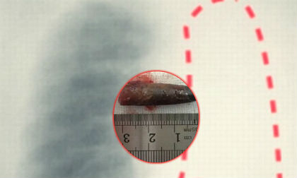 Teo một bên phổi do hít phải nắp bút 20 năm không biết