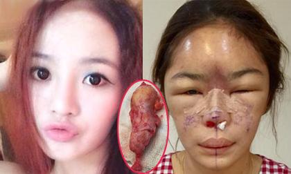 Cô gái thẩm mỹ viêm nhiễm biến dạng đáng sợ vì cắt mũi