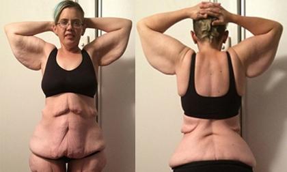 Thân hình chảy xệ vì giảm cân của cô gái nặng 220kg