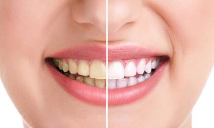 Mẹo để có hàm răng trắng sáng mà không cần tới nha sĩ