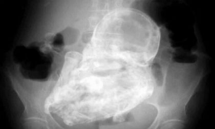 Cụ bà 92 tuổi có thai nhi chết lưu trong bụng hơn 50 năm