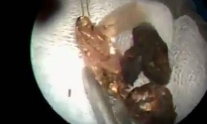 Ghê rợn gắp côn trùng từ tai người đàn ông bằng nhíp