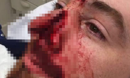 Kinh hoàng 'màn' chém lẹm mũi của bạn