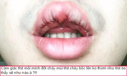 Chàng trai Hà Nội chịu đau đớn 'chết đi sống lại' để thẩm mỹ môi trái tim