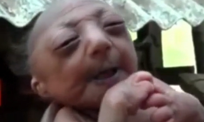 Xót xa bé 2 tuần tuổi mang gương mặt cụ già