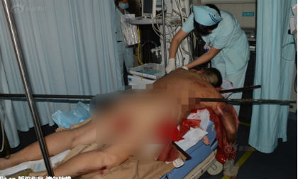 Kinh hoàng thanh sắt dài gần 2m xuyên qua người