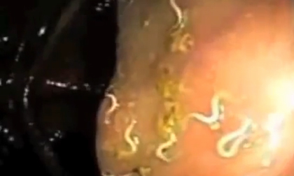 Rùng mình cảnh ký sinh trùng 'lúc nhúc' trong cơ thể người