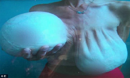 Cắt bỏ bộ ngực 'siêu khủng' gần 14kg do phẫu thuật hỏng