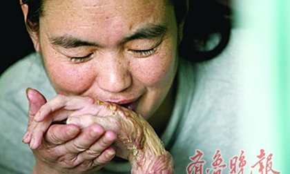 Cô gái bị đốt cháy toàn bộ bàn tay vì son dưỡng môi