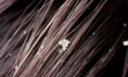 8 phương pháp độc đáo trị gàu ngày hè