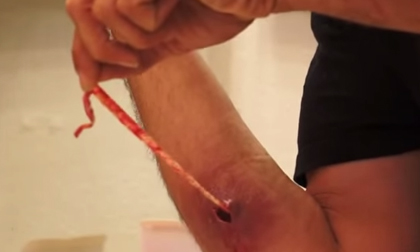 Rợn người giun sống ký sinh ở tay người