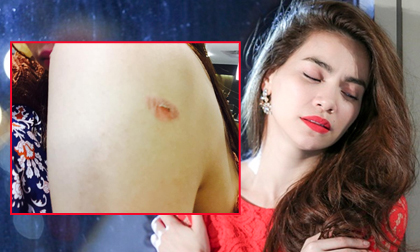 Hồ Ngọc Hà lên Facebook 'than thở' vì bị bỏng