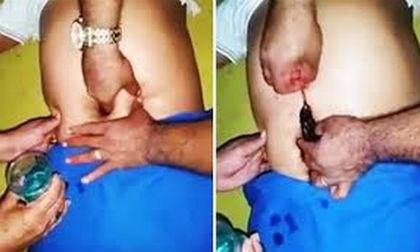 Kéo chuột chết từ trong rốn người ghê rợn