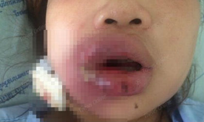 Cô gái bị lở loét viêm nhiễm miệng vì làm đẹp