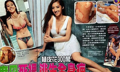 Sao nữ xứ Đài công khải ảnh bỏng nặng toàn thân