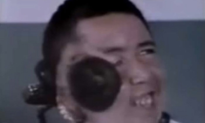 Kỳ lạ: Người đàn ông mọc thêm miệng và não trên mặt