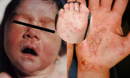 Bé 4 tuổi bị bệnh phụ khoa vì tắm ở bể bơi