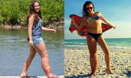 Cô gái có cái chân phải khổng lồ