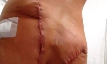 Phá tan nát vòng 3 vì phẫu thuật thẩm mỹ