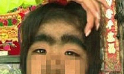 Bé gái mắc hội chứng 'người sói' hiếm gặp