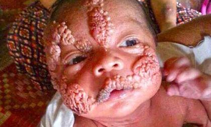 Căn bệnh lạ phá nát gương mặt em bé tội nghiệp