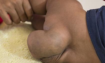 Bé trai sơ sinh có khối u to như quả bóng chày trên cơ thể