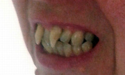 Người phụ nữ biến thành 'ma cà rồng' vì bệnh nướu răng