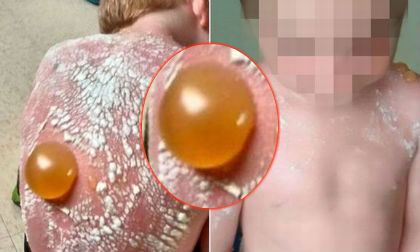 Bé 7 tuổi bị bỏng phồng rộp vì cháy nắng