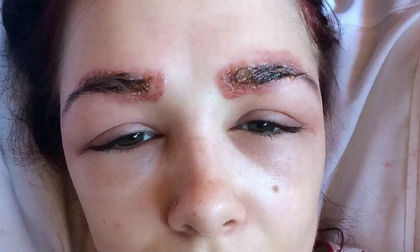 Cô gái bị sưng phù nề mắt vì nhuộm lông mày