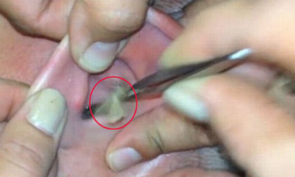 Trường hợp bị côn trùng 'khủng' chui vào tai ghê rợn