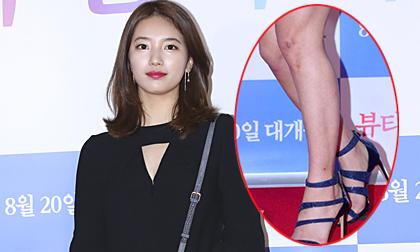 Bạn gái Lee Min Ho - Suzy lộ chân thô kệch, chi chít sẹo