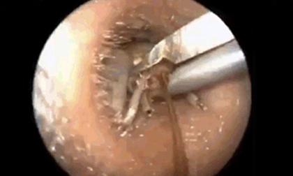 Cảnh tượng kinh hoàng gắp châu chấu còn sống ra khỏi tai người 