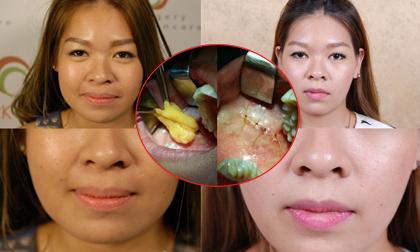 Cận cảnh quá trình cắt mỡ thu gọn má kinh hãi