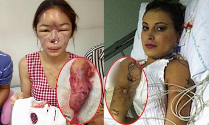 'Sợ đến già' những trường hợp thủng người thối thịt vì thẩm mỹ