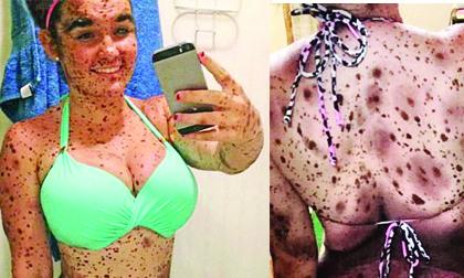 Thiếu nữ với hàng trăm vết bớt trên cơ thể như quái vật
