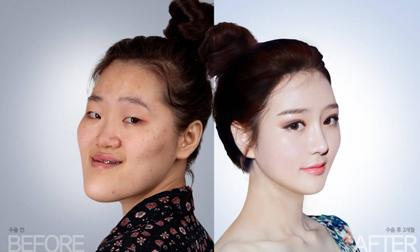 Cô gái mặt dị dạng hóa hot girl nhờ thẩm mỹ 