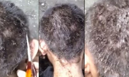 Rùng mình với mái tóc lúc nhúc ký sinh trùng