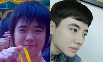 Chàng trai thẩm mỹ mũi 'lột xác' thành hot boy