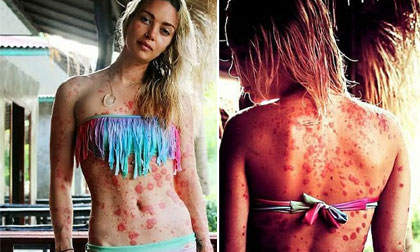Cô gái bị vẩy nến vẫn tự tin khoe cơ thể 