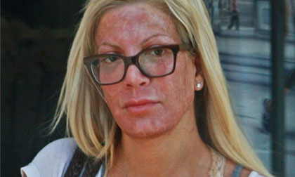 Sao nữ Hollywood gây sốc với gương mặt đỏ lừ