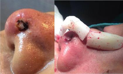 Kinh hãi cô gái có ba lỗ mũi vì thẩm mỹ hỏng