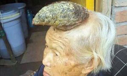 Cụ bà mọc 'sừng' trên đầu dài 13cm