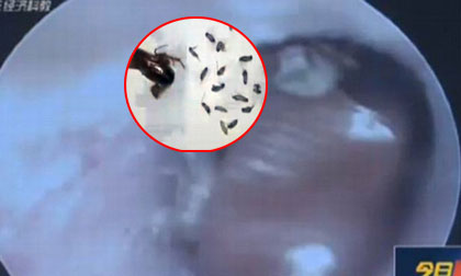 Phát hiện ổ gián sống trong tai người