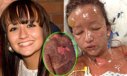 Kinh hãi cô gái biến dạng như yêu quái vì dùng thuốc chữa đau dạ dày 